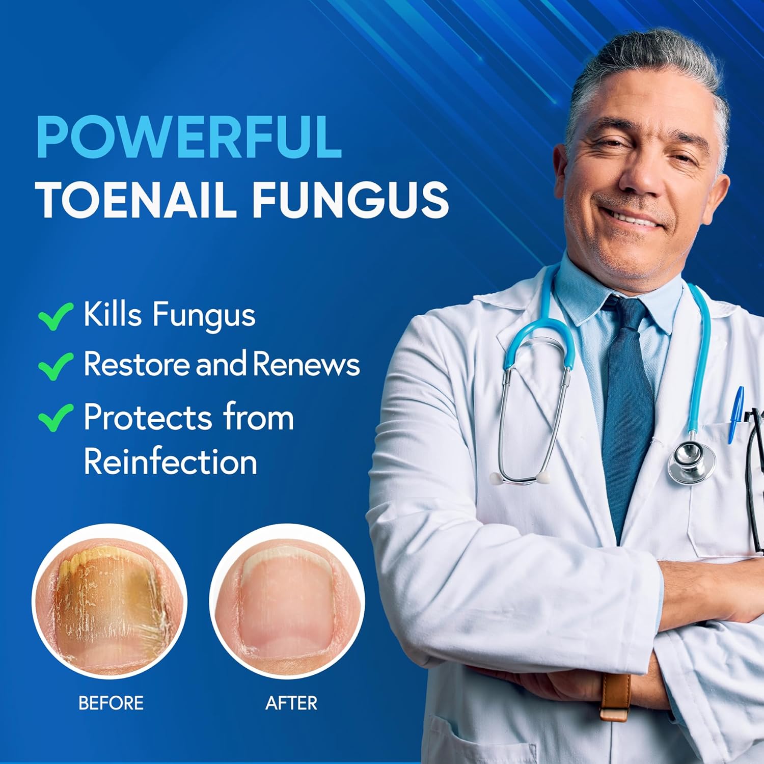 Toenail Fungus Treatment Extra Strength with 25% Undecylenic Acid & Tea Tree Oil, Nail Fungus Treatment for Toenail & Fingernails, Antifungal Nail Treatment for Damaged Nails and Thick Toenails- 2Pcs