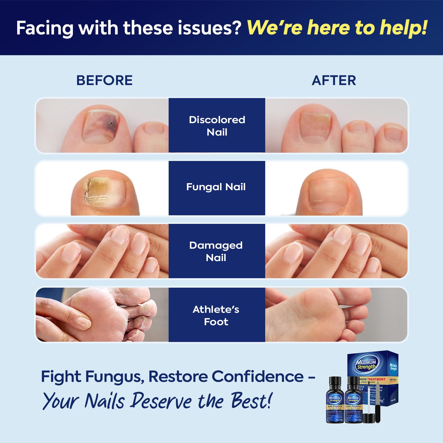 Toenail Fungus Treatment with 25% Undecylenic Acid, Toe Fungus Treatment for Toenail, Fungus Nail Treatment, Toenail Fungus Treatment Extra Strength, Fungal Nail Treatment for Athletes Foot - 2pcs