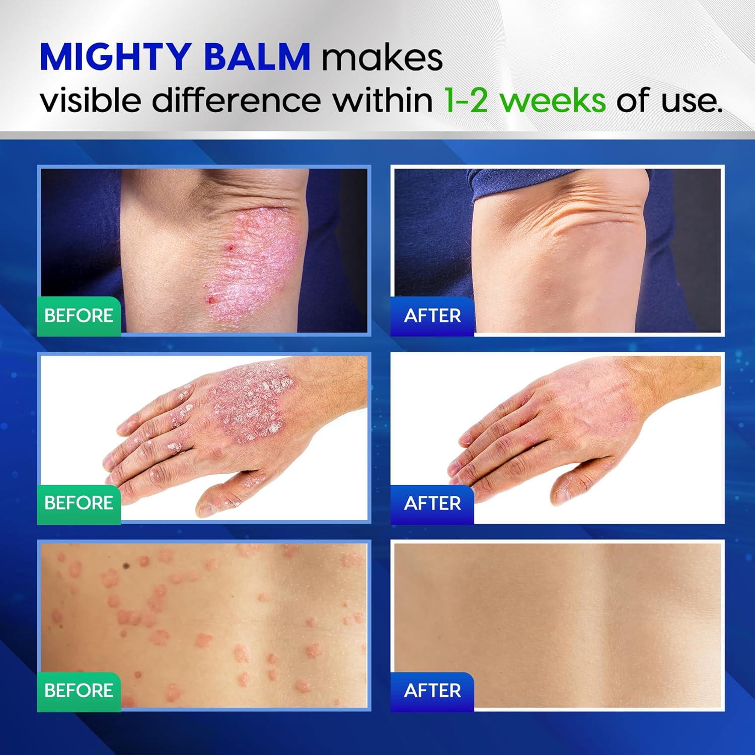 Tobcharm Antifungal Cream with Tea Tree Oil for Ringworm, Jock Itch, Athlete’s Foot, and Fungal Skin Infections – Anti-Fungal Foot Cream for Fast Relief and Healing