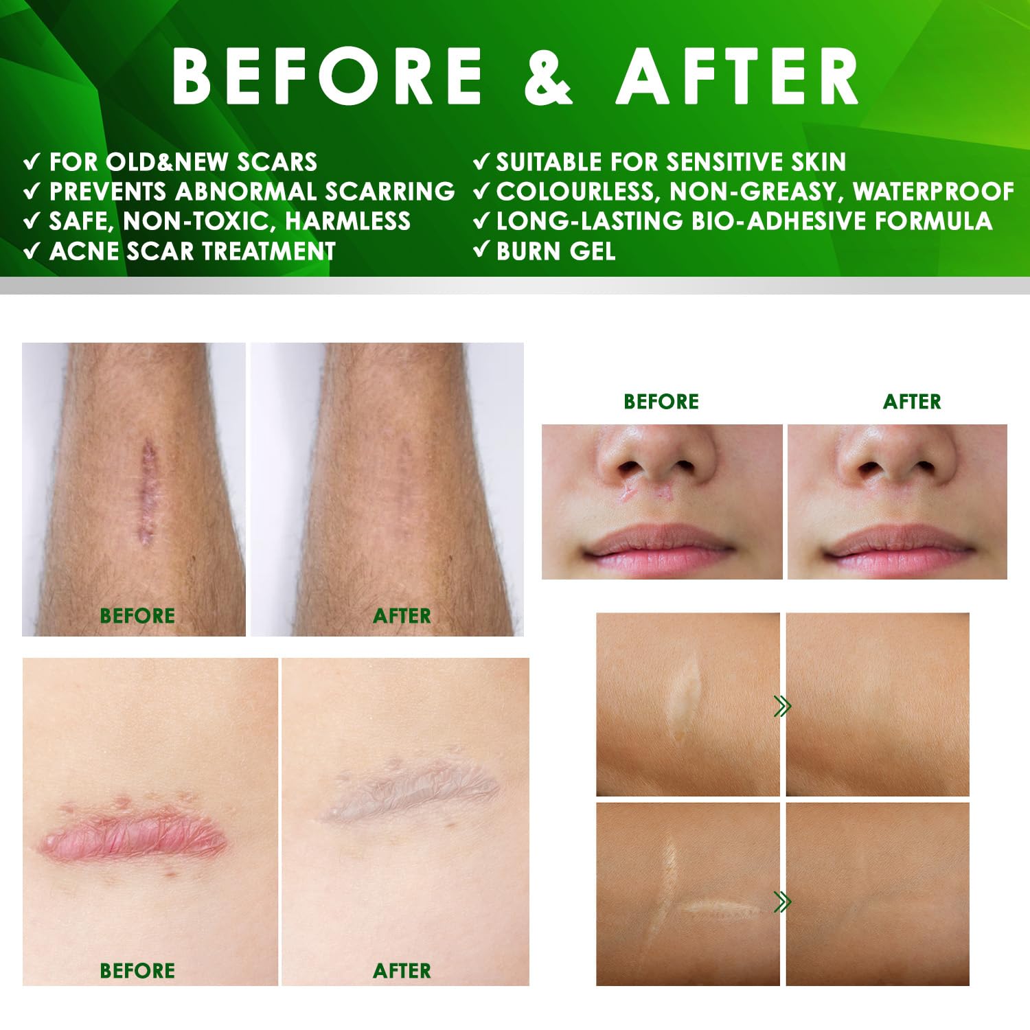Advanced Keloid Bump Removal Gel (3 Packs): Silicone Keloid Scar Removal Cream for Scars from Piercing, Surgical Marks, Acne, and Burns, Keloid Treatment for Ears, Face, and Body with Healing Formula