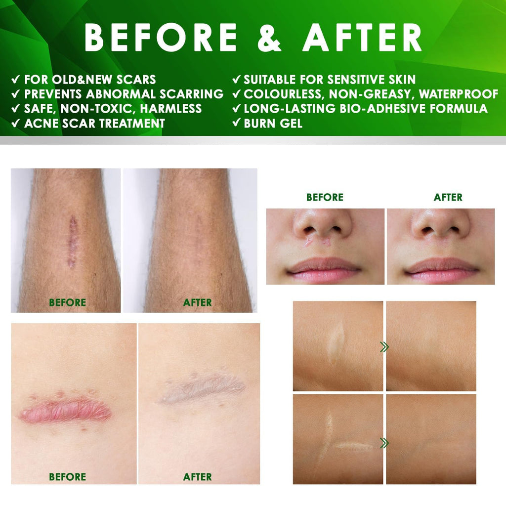 Advanced Keloid Bump Removal Gel: Silicone Keloid Scar Removal Cream for Scars from Piercing, Surgical Marks, Acne, and Burns, Keloid Treatment for Ears, Face, and Body with Healing Formula 30g