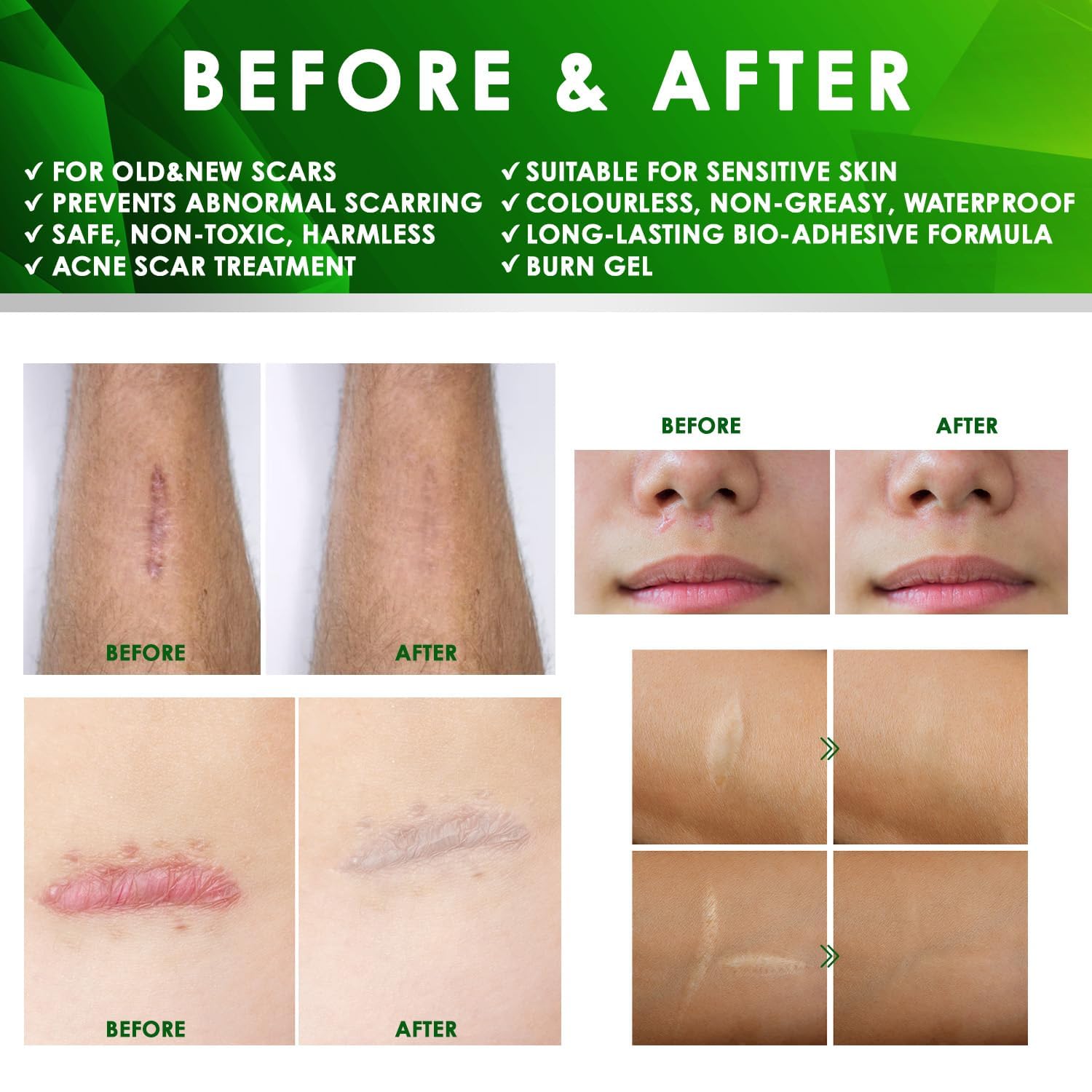 Advanced Keloid Bump Removal Gel: Silicone Keloid Scar Removal Cream for Scars from Piercing, Surgical Marks, Acne, and Burns, Keloid Treatment for Ears, Face, and Body with Healing Formula 30g